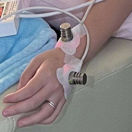 靜脈雷射 靜脈雷射